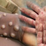 DSÖ’den M çiçeği virüsü uyarısı: Salgın kıtayı aştı! ‘Kontrol altına alınmalı’