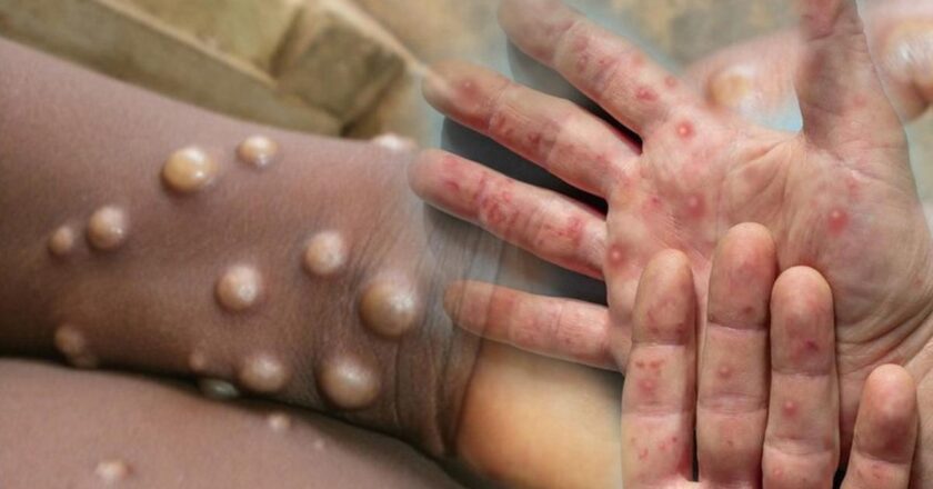 DSÖ’den M çiçeği virüsü uyarısı: Salgın kıtayı aştı! ‘Kontrol altına alınmalı’