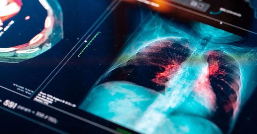 Türkiye’de her yıl 45 bin yeni vaka! Bu illere dikkat: Risk daha fazla!